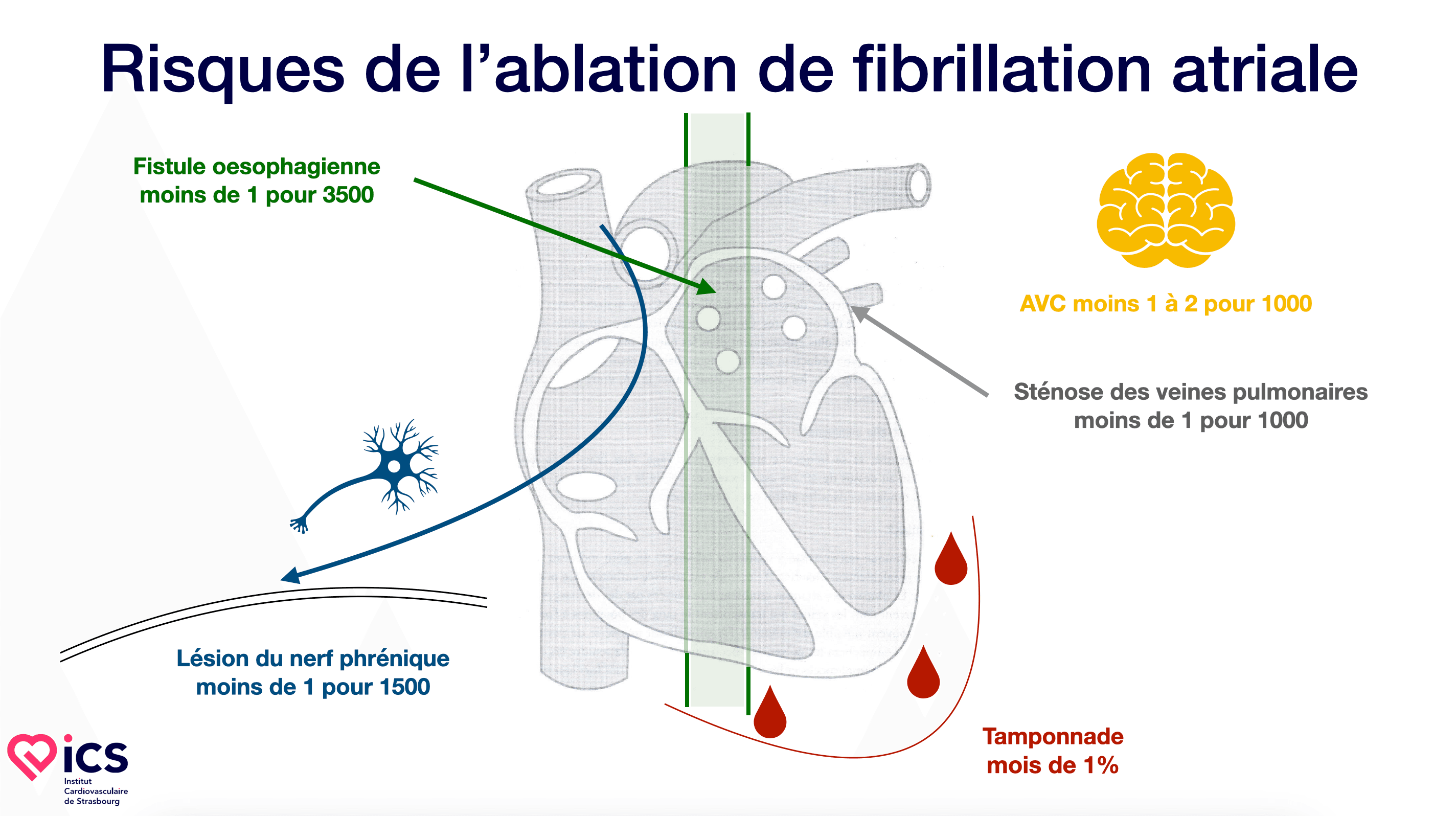 Risques de l'ablation de fibrillation atriale