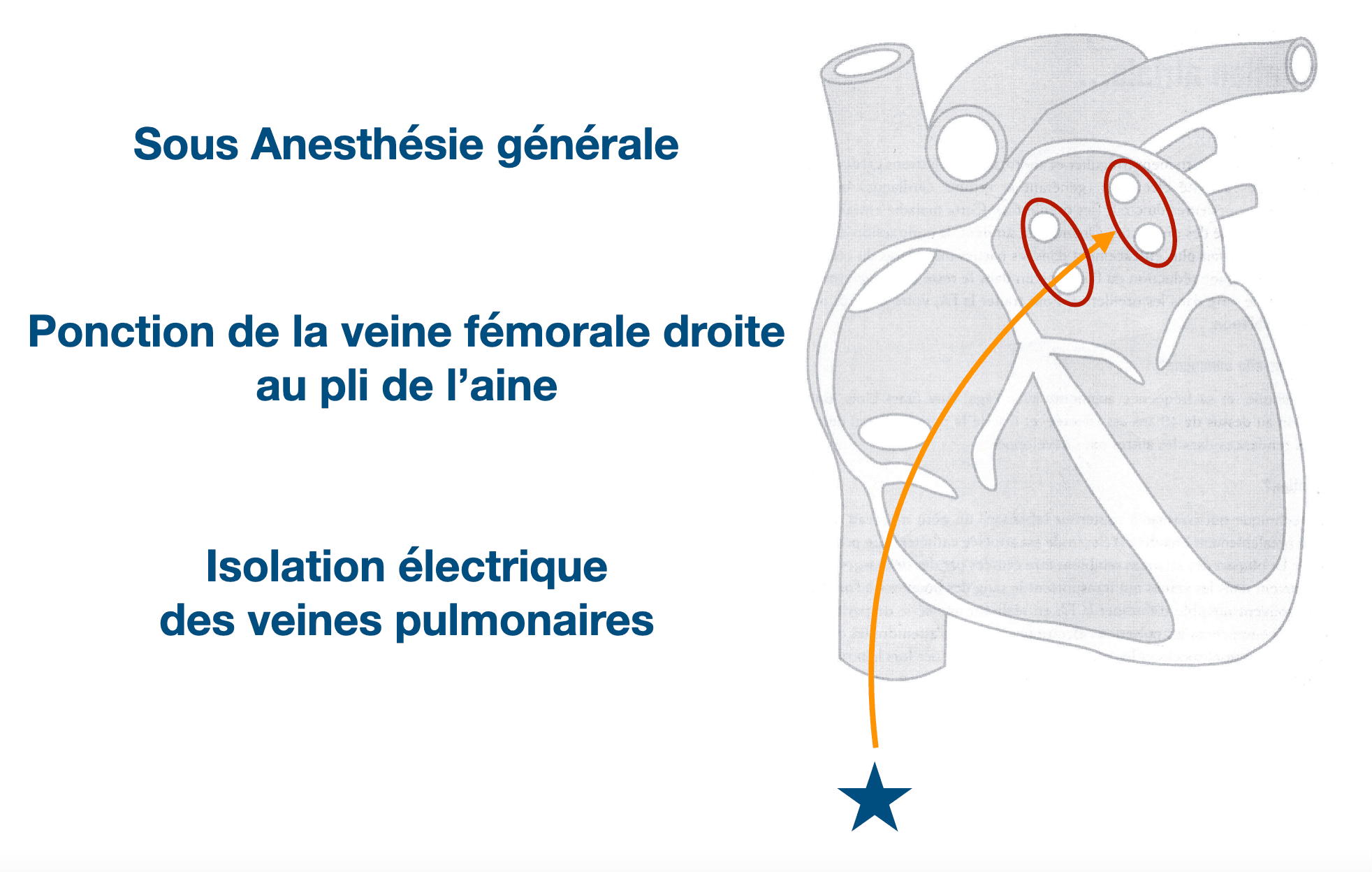 Comment se déroule une ablation de fibrillation atriale dans notre centre ?