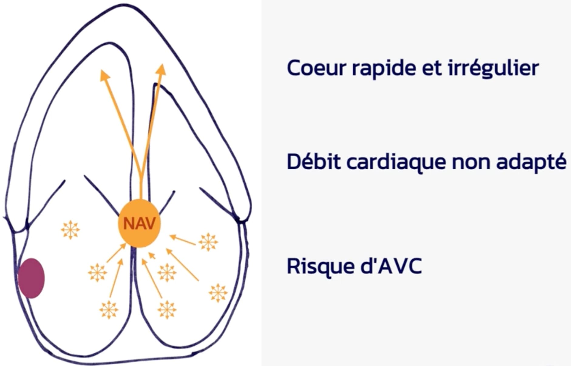 Fibrillation atriale : quelles sont les conséquences sur le cœur et la santé ?