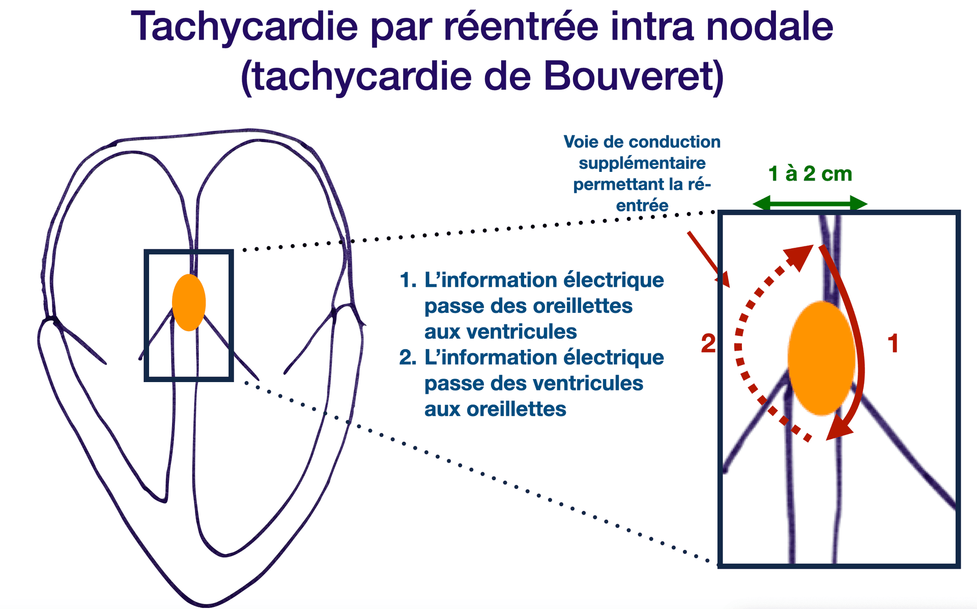 La tachycardie de Bouveret