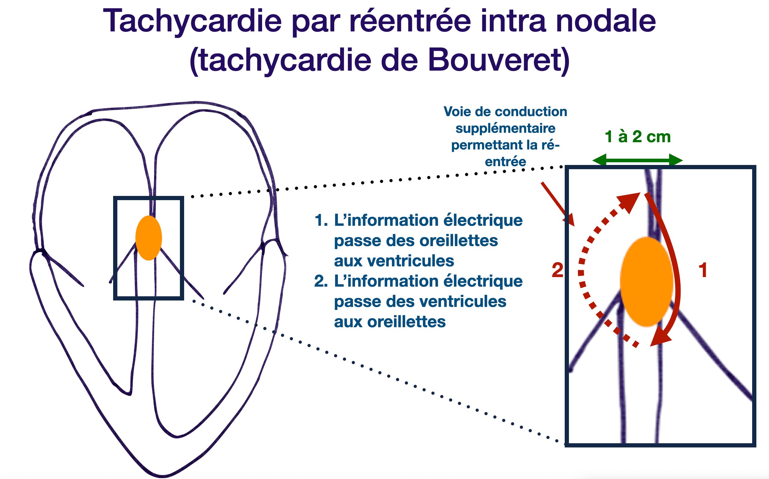 La tachycardie de Bouveret